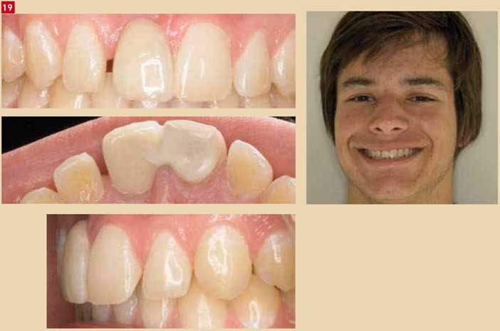 dents-adjacentes
