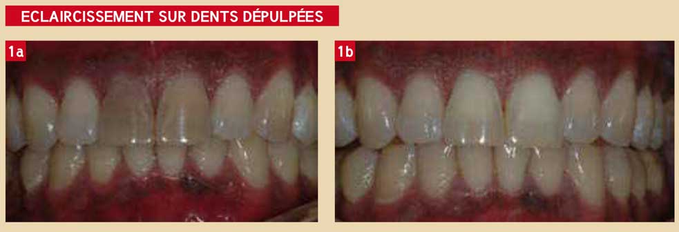 eclaircissement-sur-dents-dépulpées