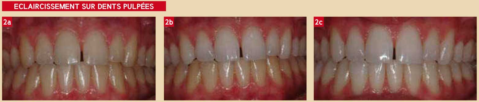 eclaircissement-sur-dents-pulpées