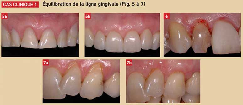 equilibration-du-ligne-gingivale