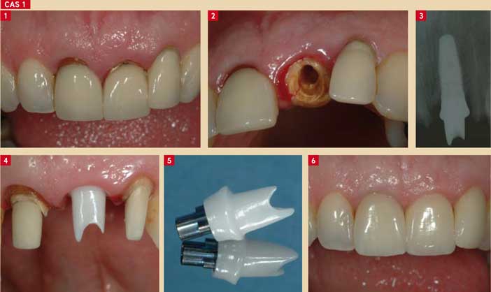 extraction-et-implantation