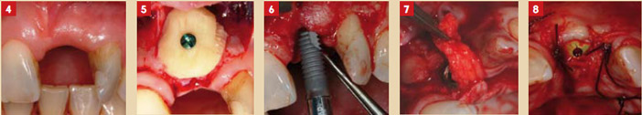 focus-clinic-edentation-gestion-tissus-et-implant-4-5-6-7-8