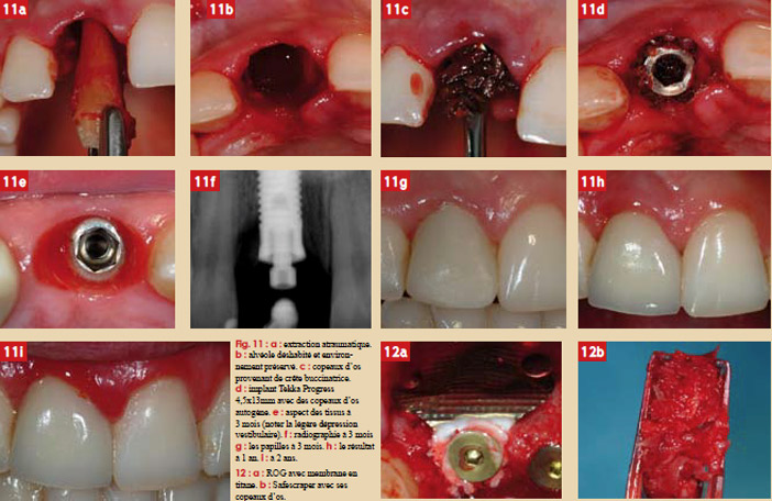 focus-clinic-edentation-gestion-tissus-et-implant