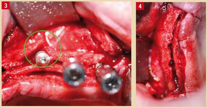 fracture-de-la-corticale