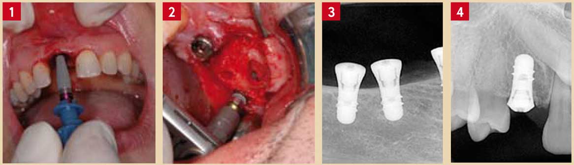 implant-de-forme-racine