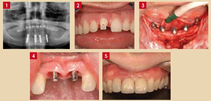 implant-de-grande-marque