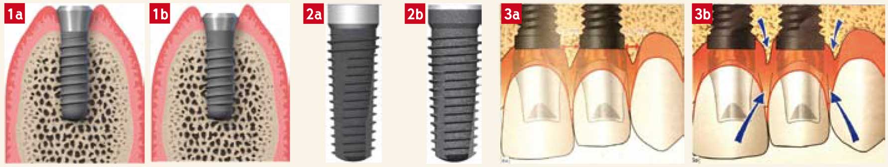 implant-en-un-temps