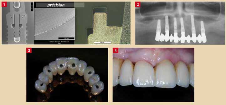 les-criteres-de-choix-d’un-bon-implant