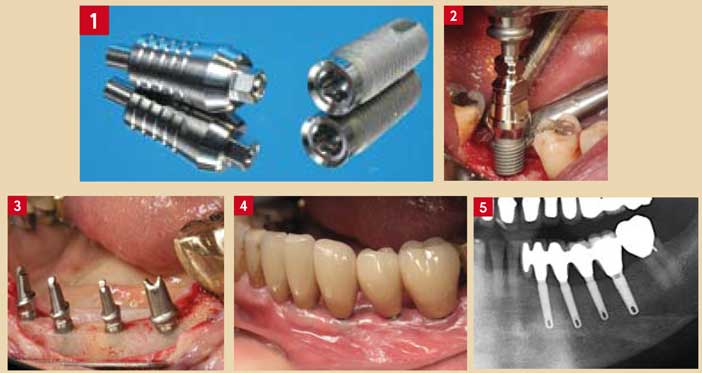 les-critères-de-choix-d’un-bon-implant