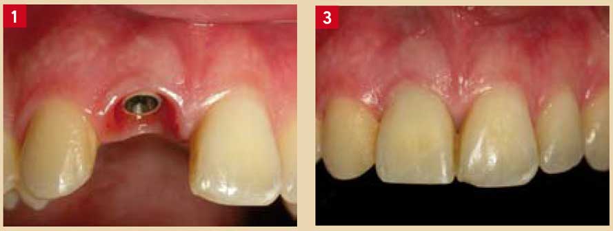 les-critères-de-choix-d’un-bon-implant