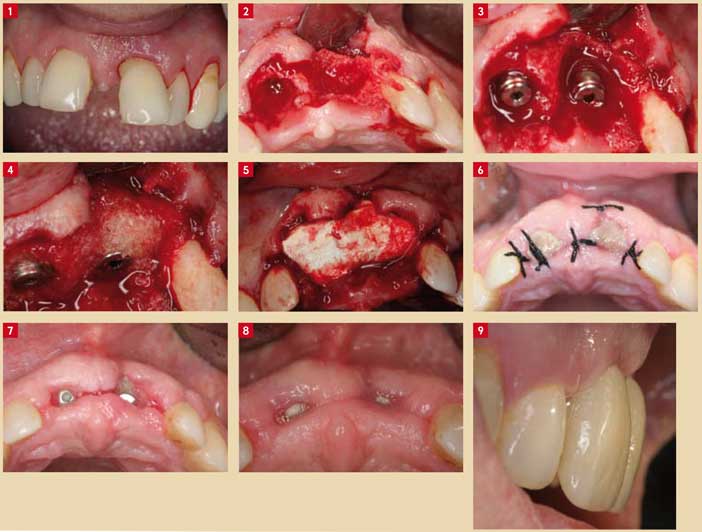 mises-en-place-des-implants