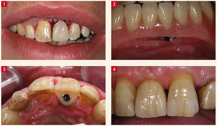 Ciment dentaire définitif pour la fixation de ponts et couronnes