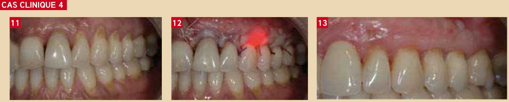 récessions-gingivales-multiples