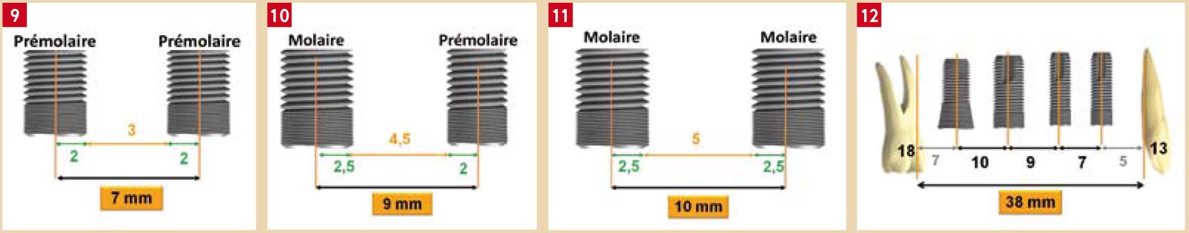 Édentement-plural-antérieur