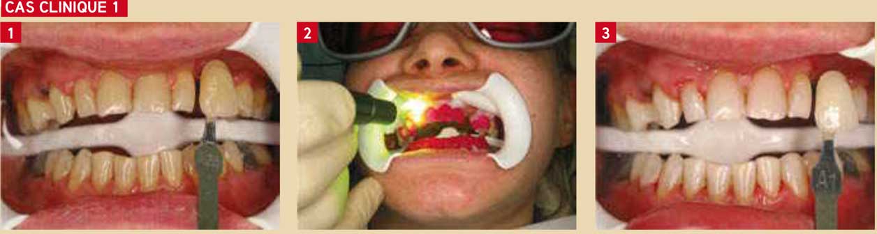 éclaircissement-dentaire