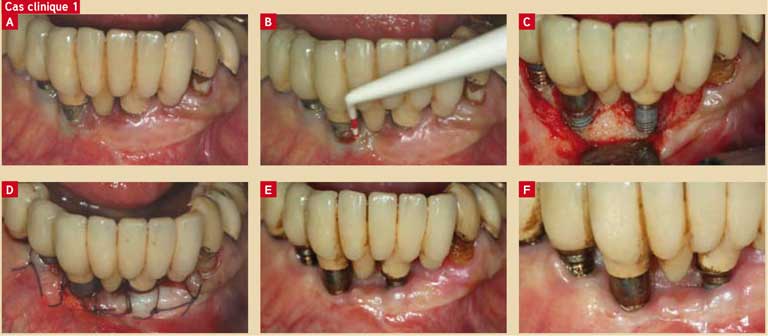 Traitement-d-une-péri-implantite