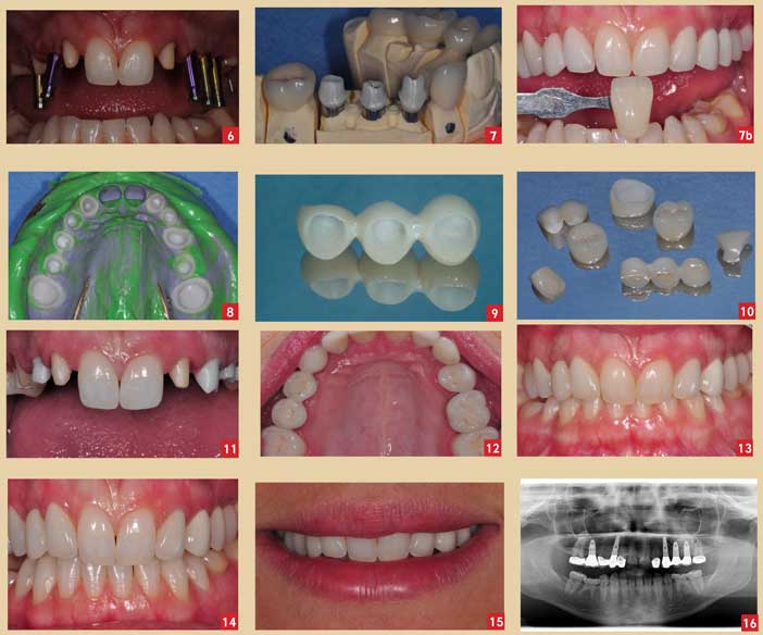 moignons-en-zircone