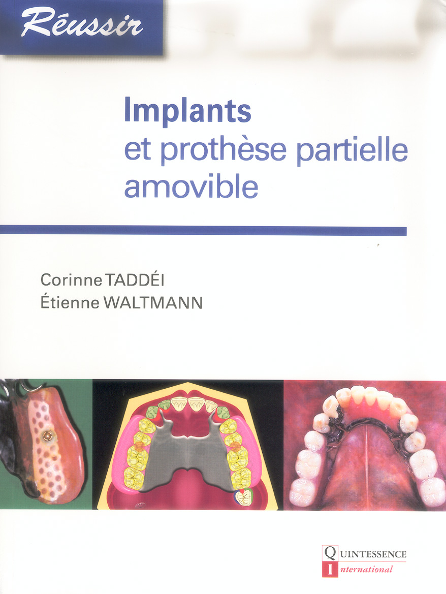 Implants et prothèse partielle amovible