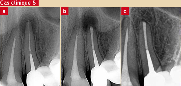 Gestion-du-tiers-apical