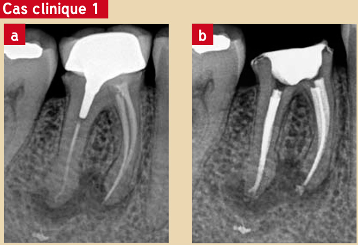 Évaluation-du-traitement-endodontique