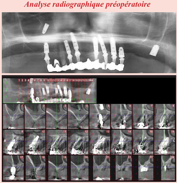 Analyse-radiographique-préopératoire