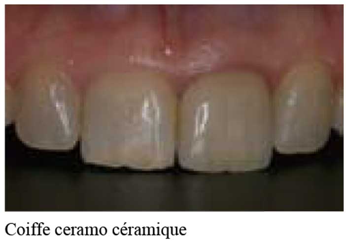 Coiffe-ceramo-céramique