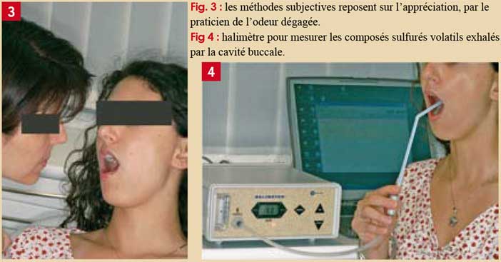 Evaluation-de-la-mauvaise-haleine