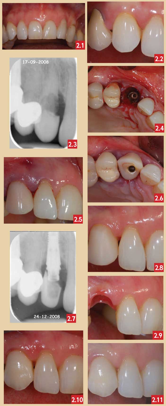 L’extraction-implantation-immédiate