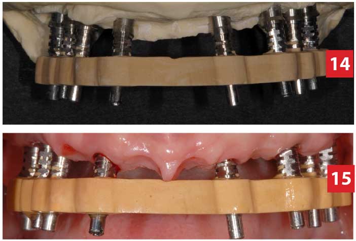 armatures-direct-implant