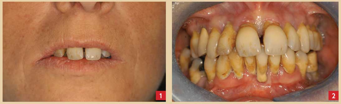 extraction-implantation-immédiate