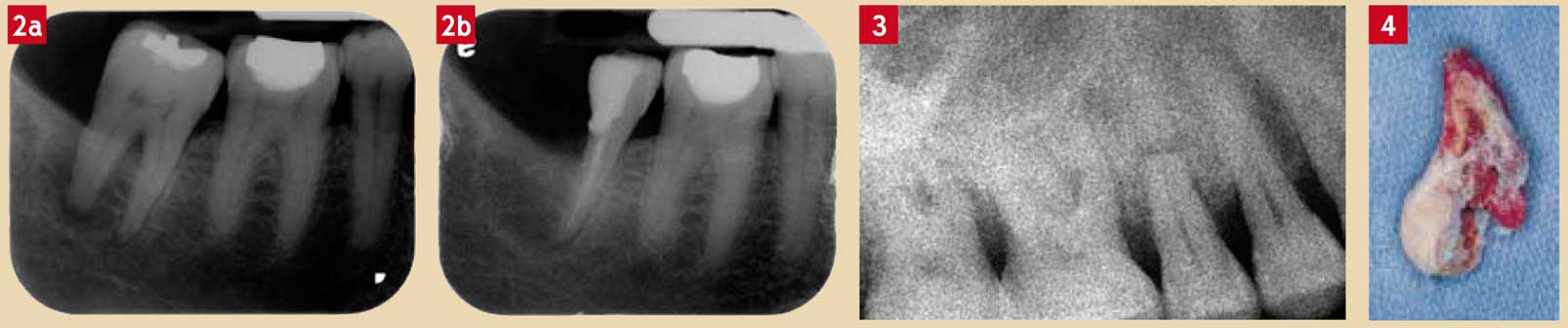 fracture-radiculaire