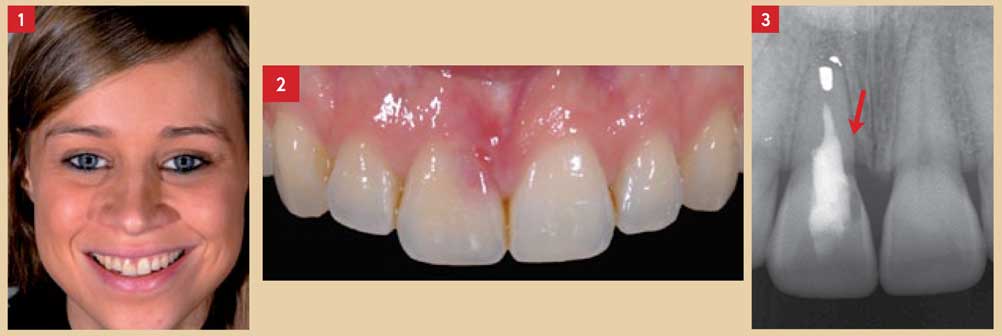 inflammation-gingivale