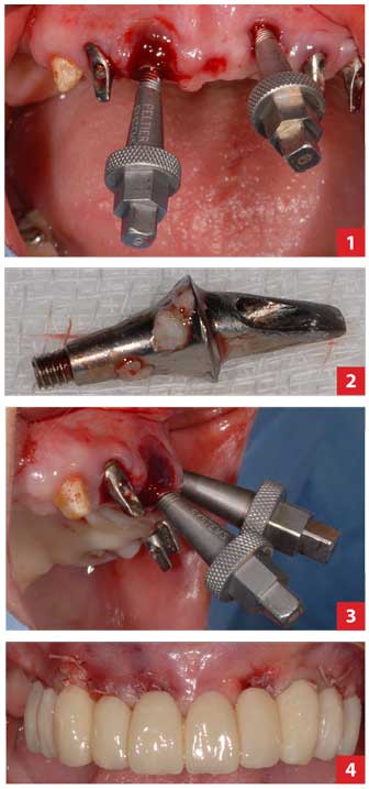 la-dépose-des-implants