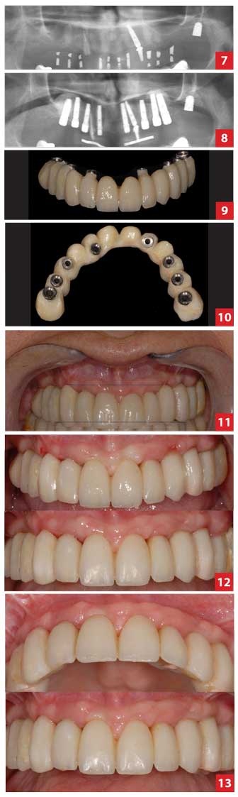 le-bon-positionnement-des-implants