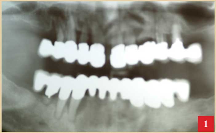 parodontal-infectieux
