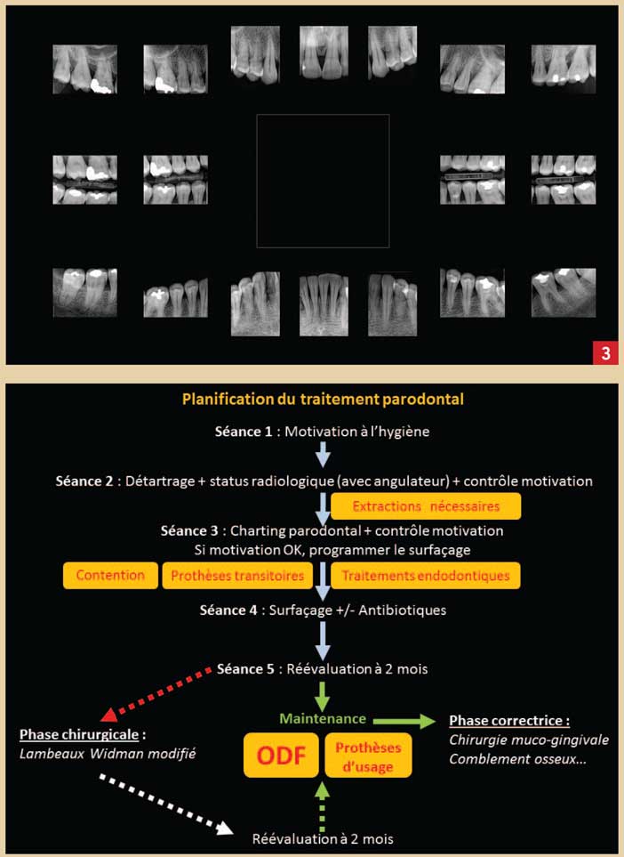 planification-du-traitement-parodontale