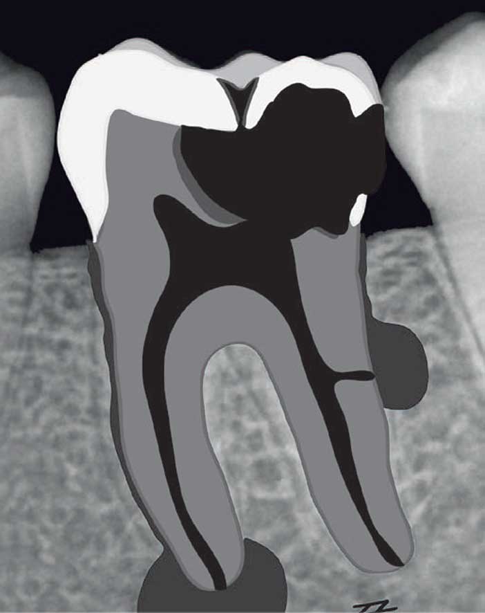 La-parodontite-apical-aigue