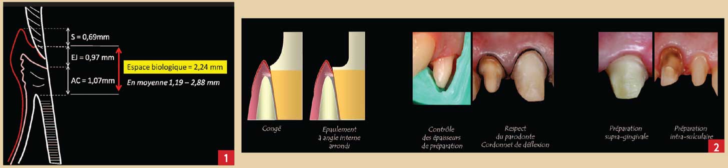 Les-différentes-formes-de-limites-cervicales