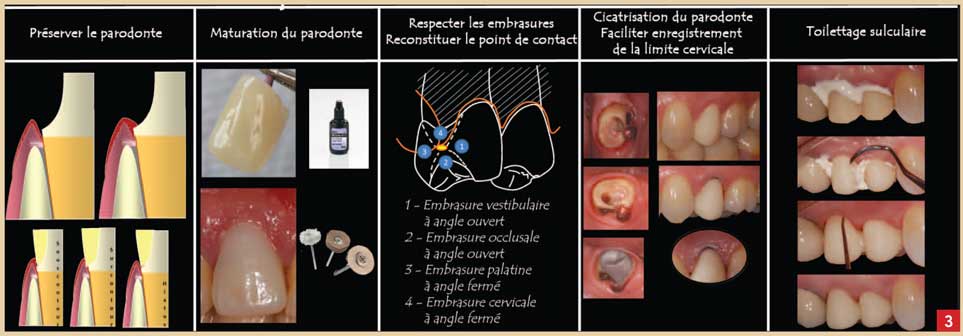 Les-prothèses-transitoires