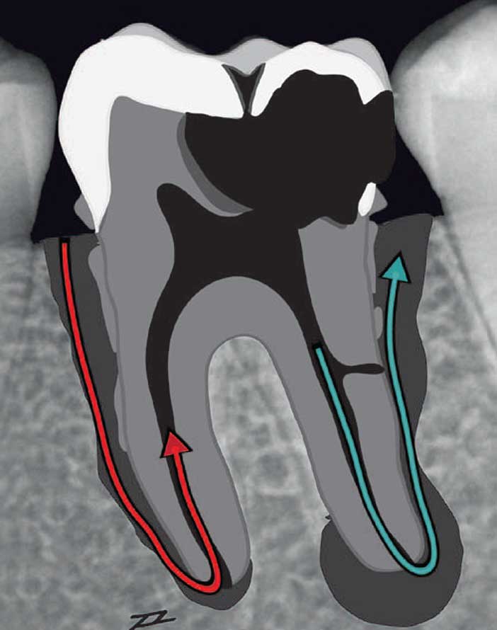 Lésions-endodontiques-et-parodontales