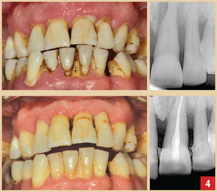 cicatrisation-gingivale