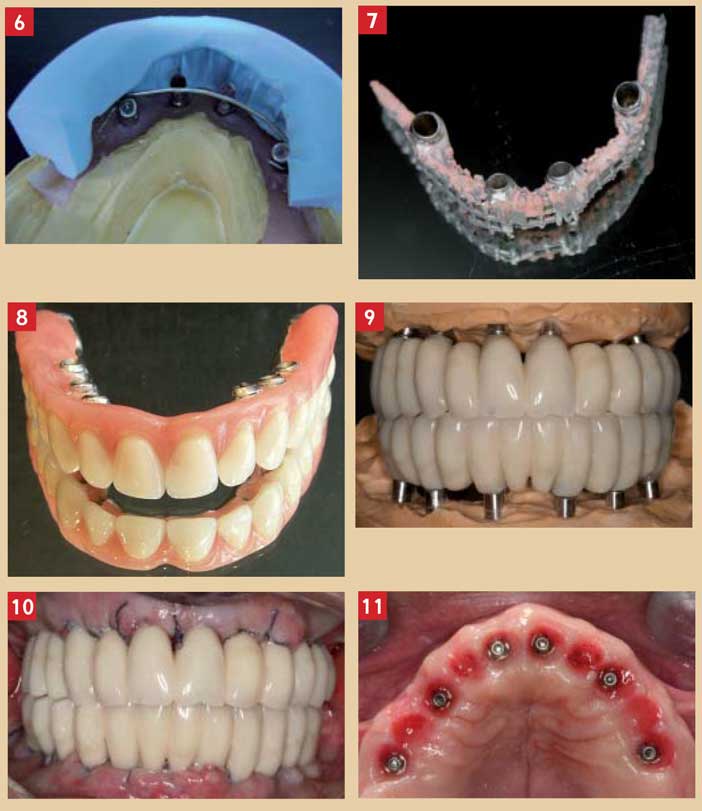 Charge immédiate sur implant dentaire - Des dents provisoires directement