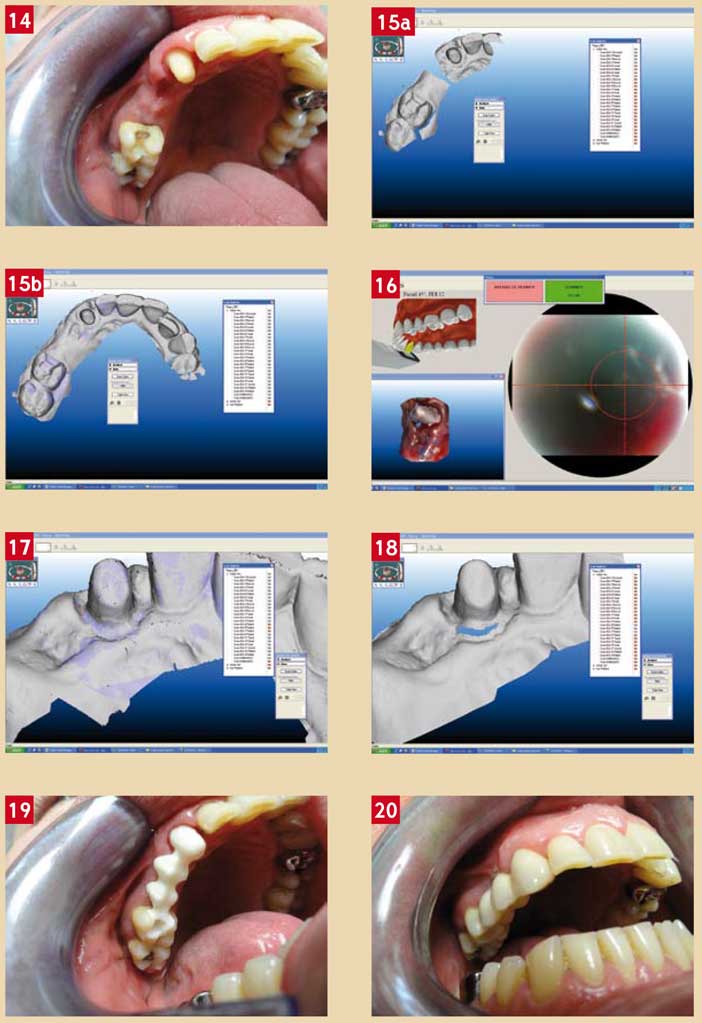 essayage-armature-zircone