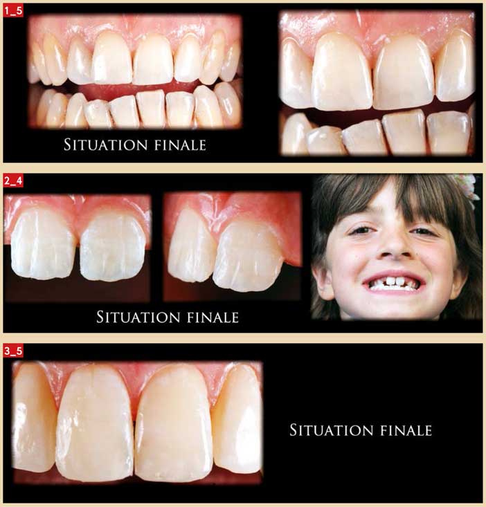 angles-de-transition