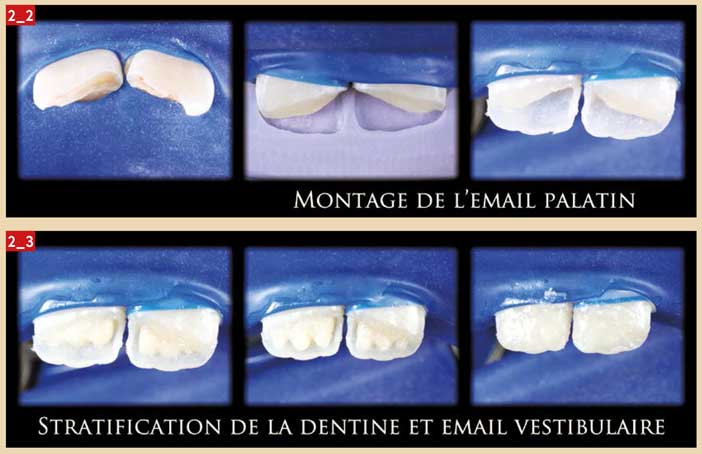 stratification-de-la-dentine