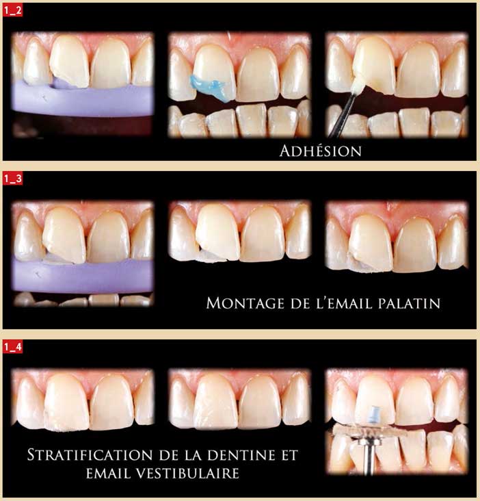 teinte-de-l-émail