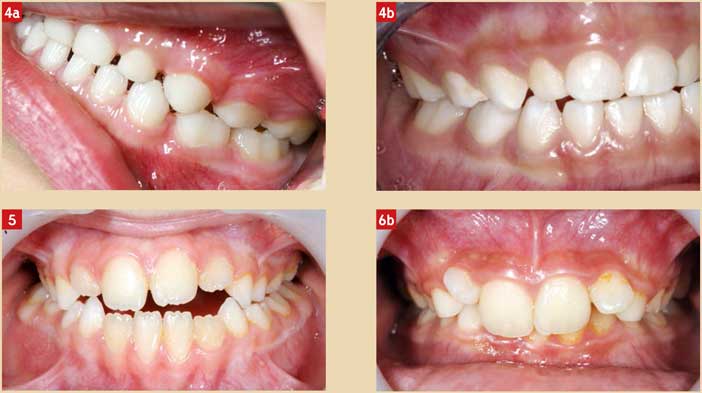 denture-temporaire