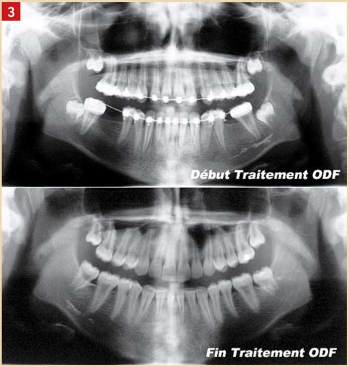 le-traitement-orthodontique