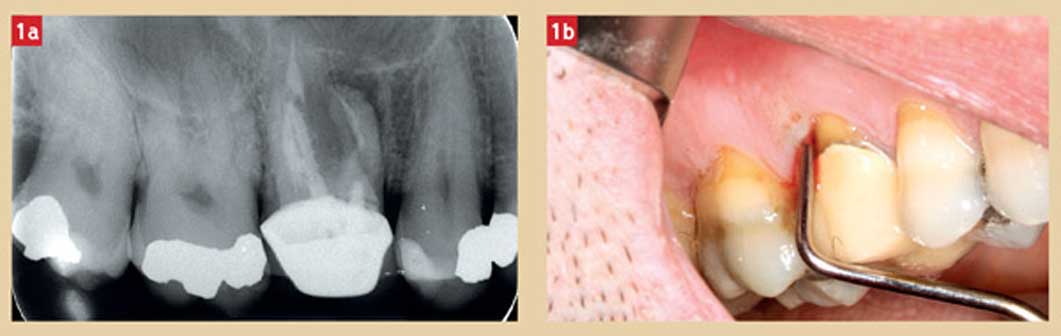 radiographie-dent-a-extraire