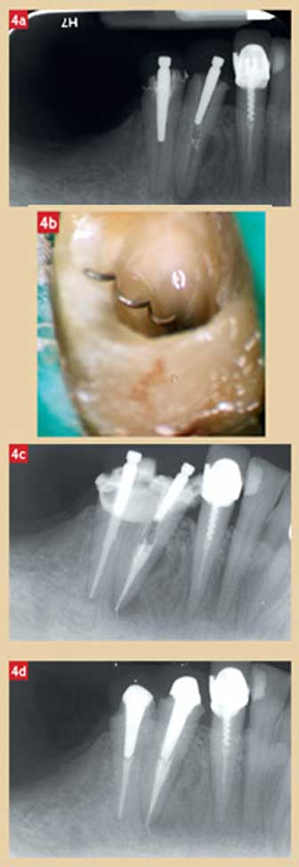 radiographie-post-operatoire